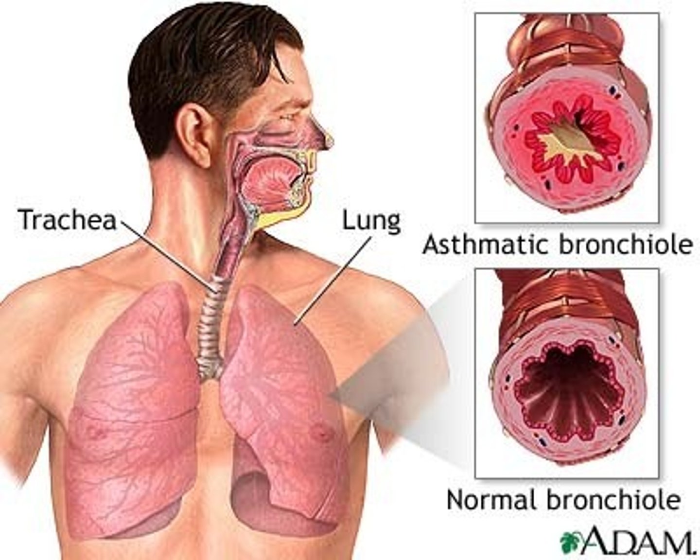 <p>Smooth muscle dysfunction: In an asthmatic lung, the muscles become tight (constricted) which reduces the lumen. The lining becomes swollen so the lumen of the airway becomes even tighter. Inflammatory mediator release.</p><p>Epithelial dysfunction: There is excess mucous production.</p><p>- Airway remodelling</p><p>- Cellular proliferation</p><p>- Epithelial activation</p><p>There is smooth muscle dysfunction AND airway inflammation which cause asthma symptoms.</p>