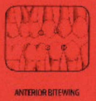 <p>-Between half the canine and the pulp chamber of the 1st premolar</p>