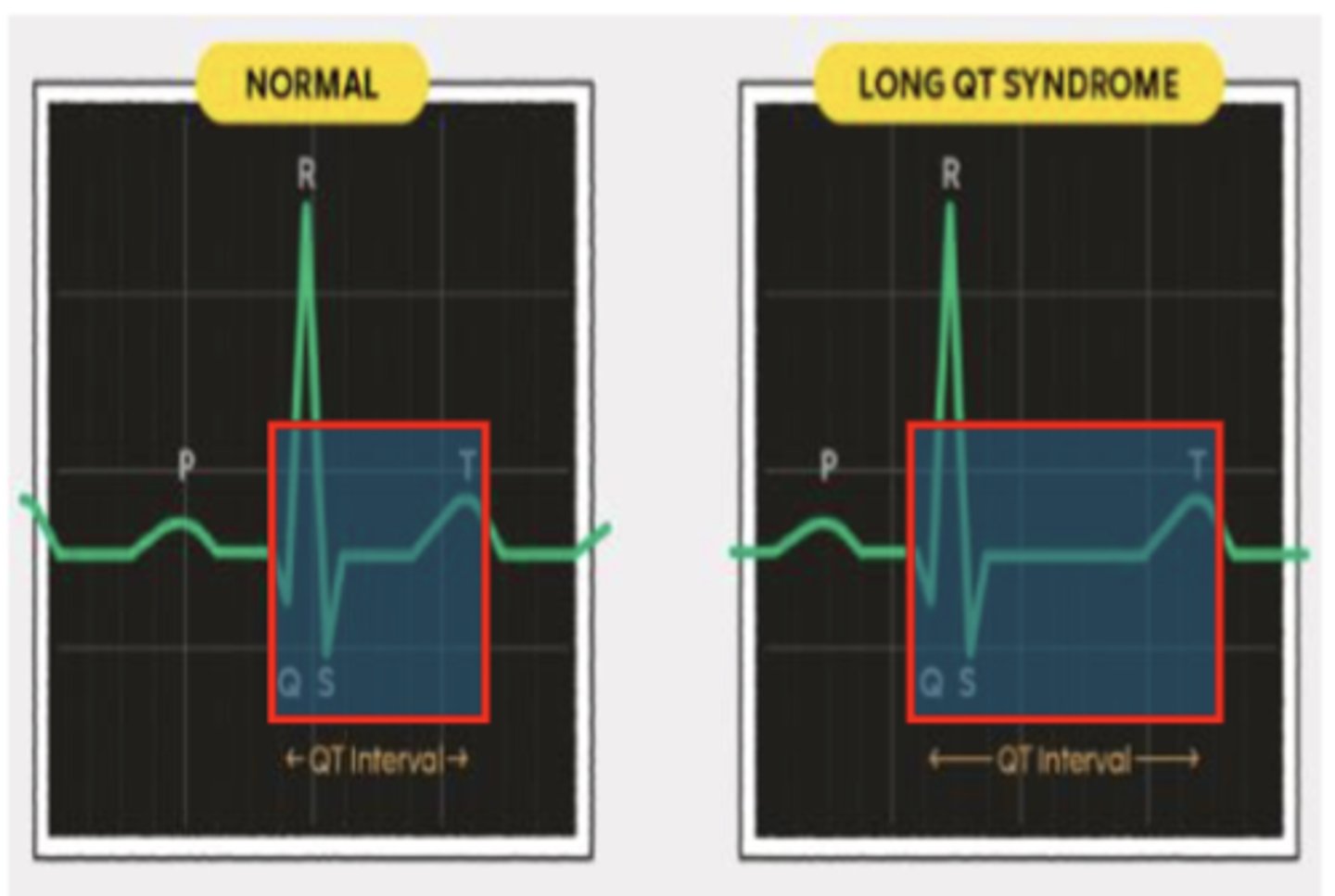 <p>Abnormal heart electrical system where it takes the heart longer to recharge between beats</p>