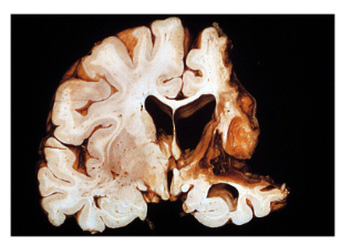 <p>What type of brain lesion is this?</p>