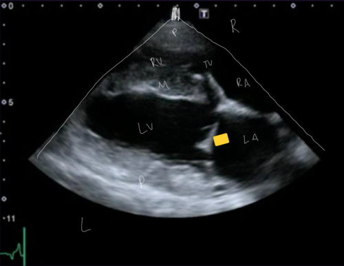 <p>Right Parasternal Long Axis View</p>