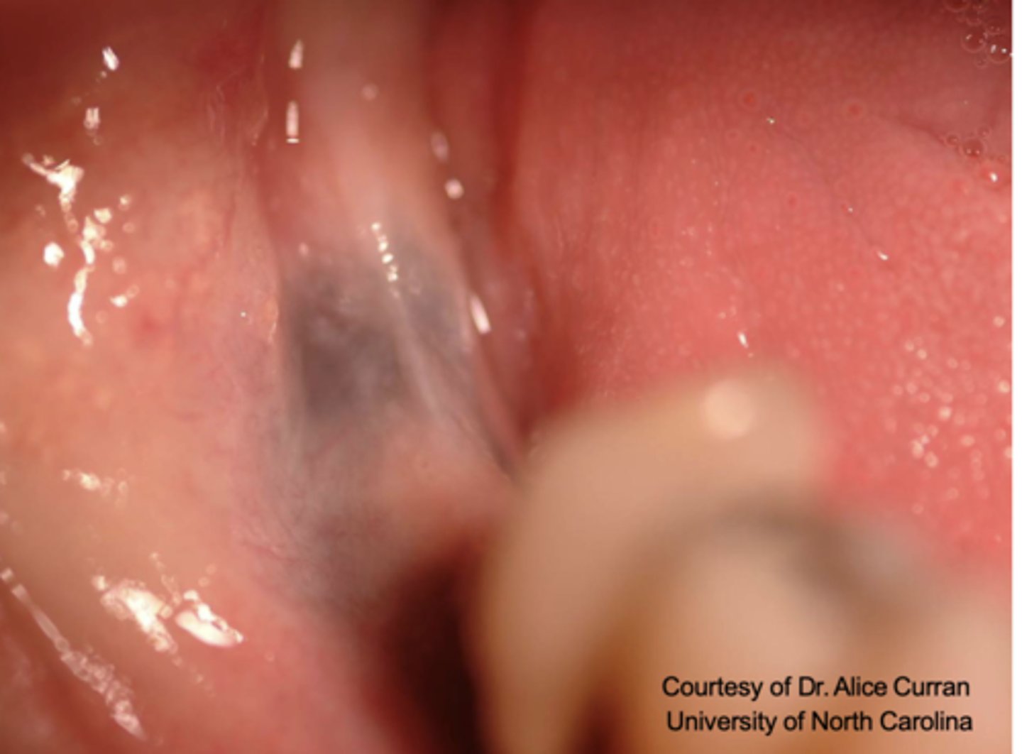 <p>What type of pigmented lesion?</p>