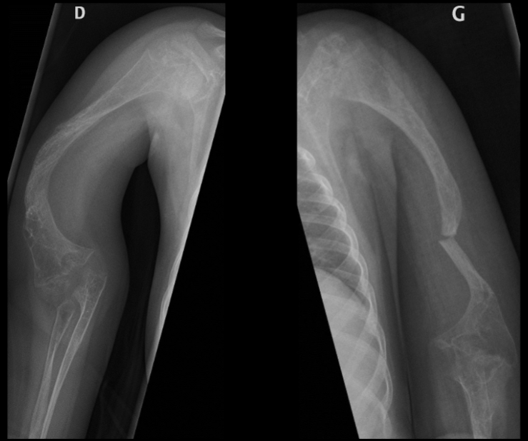 <p>what is seen here for this case of osteogenesis imperfecta?</p>