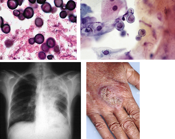 <p><strong>Cutaneous disease</strong> occurs via <strong>hematogenous spread</strong> from the lungs. Skin lesions can be <strong>pustular, papular, or nodular</strong>, usually painless and on exposed areas like the <strong>face, scalp, neck, or hands</strong>.</p>