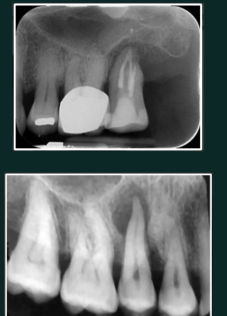 <p>Developmental/odontogenic RL lesions</p><p>RL between roots of vital tooth&nbsp;</p><p>well circumscribed&nbsp;</p>