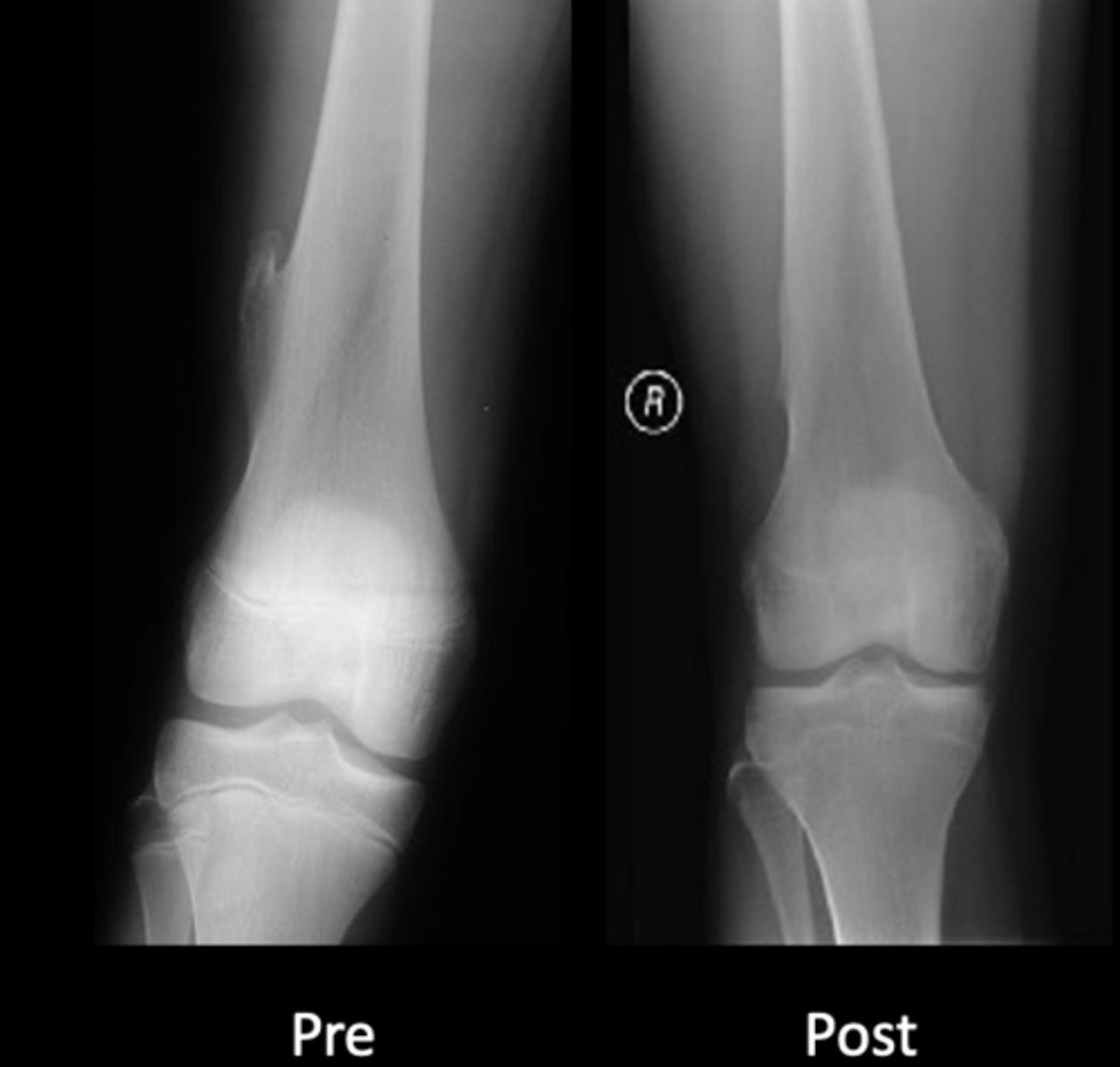 <p>State osteochondroma treatments</p>