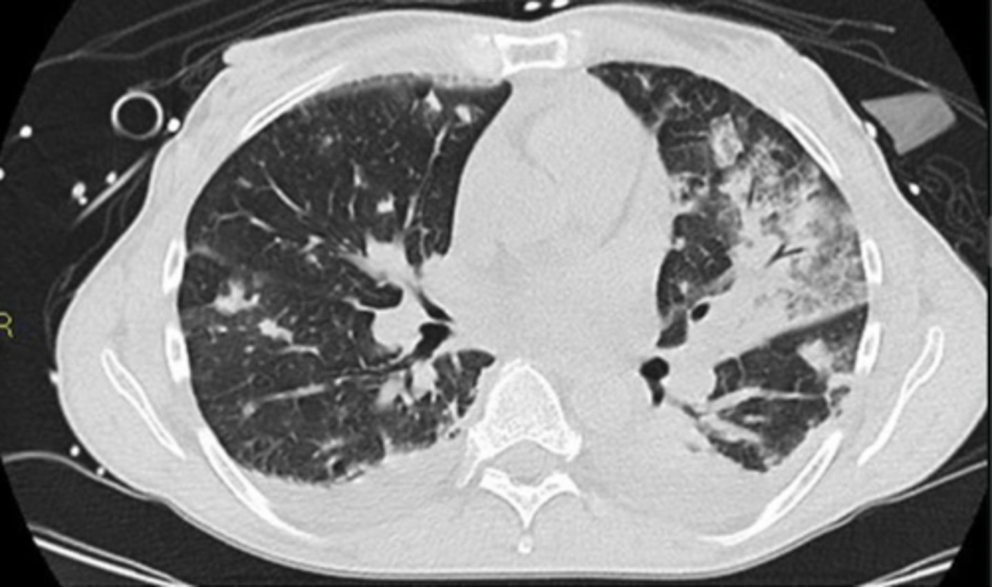 <p>Name the condition</p>