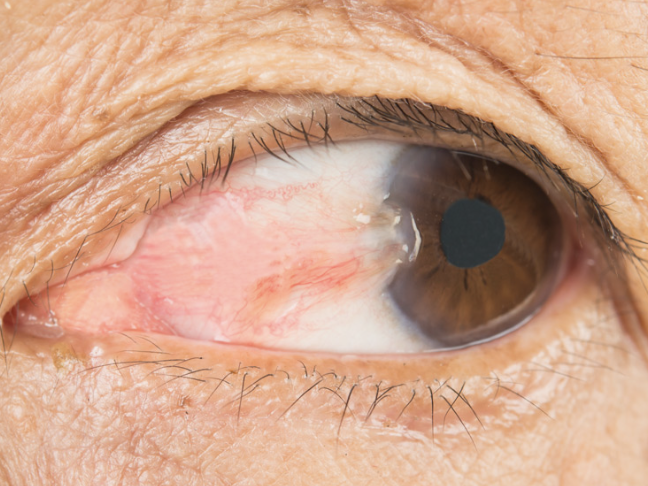 <p>One of the 6 Corneal Abnormalities</p><ul><li><p><strong>Thickening</strong> of the <strong>bulbar conjunctiva </strong>that extends <strong>across the nasal side</strong></p></li></ul><p></p>