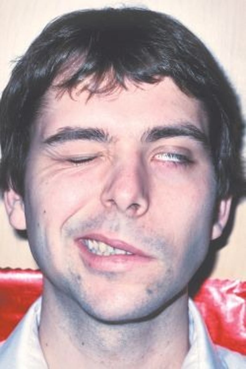<p>Bell palsy face</p>