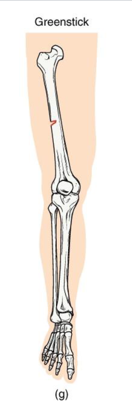 <p><strong>Definition: Incomplete break </strong>- bone bends and cracks on one side</p><p><strong>Mechanism</strong>: common in children (softer, more flexible bone)</p><p><strong>Clinical note: Often associated with forearm fractures in pediatrics.</strong></p><p><strong>Key concept</strong>: compare to bending a green twig - it splinters but doesnt snap</p>