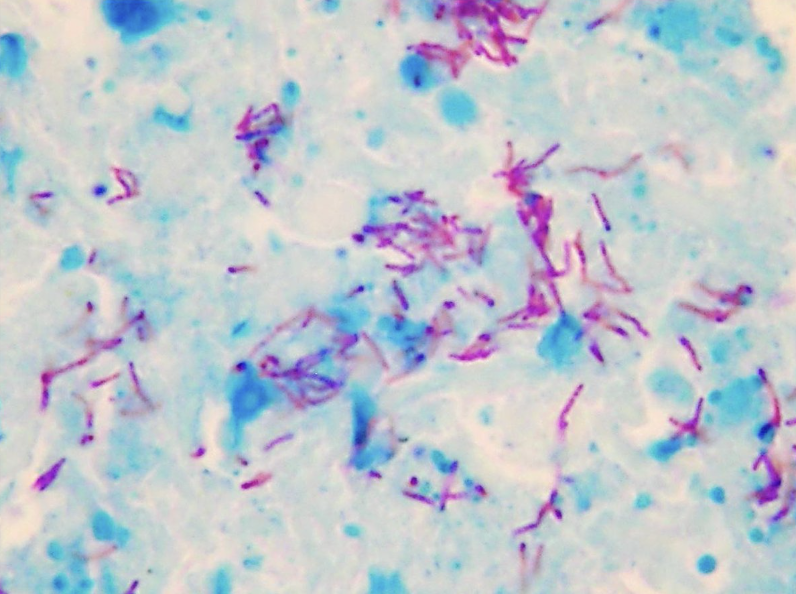 What example of acid-fast staining is this?