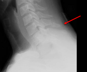 <ul><li><p>oblique fracture through the spinous processes of C7 (at times C6)</p></li><li><p>Often significantly displaced </p></li><li><p>Stable injury, the ligaments remain intact</p></li><li><p>Often found as a incidental finding many years post injury</p></li></ul><p></p>