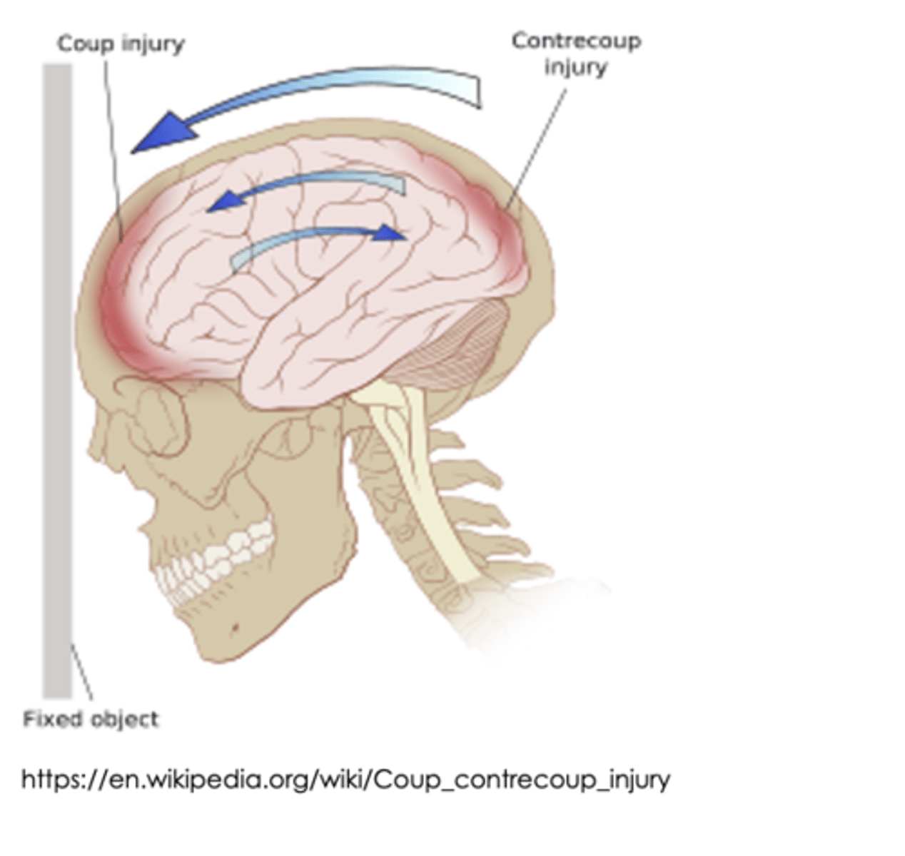 <p>multiple areas of the brain are compromised or damaged</p>