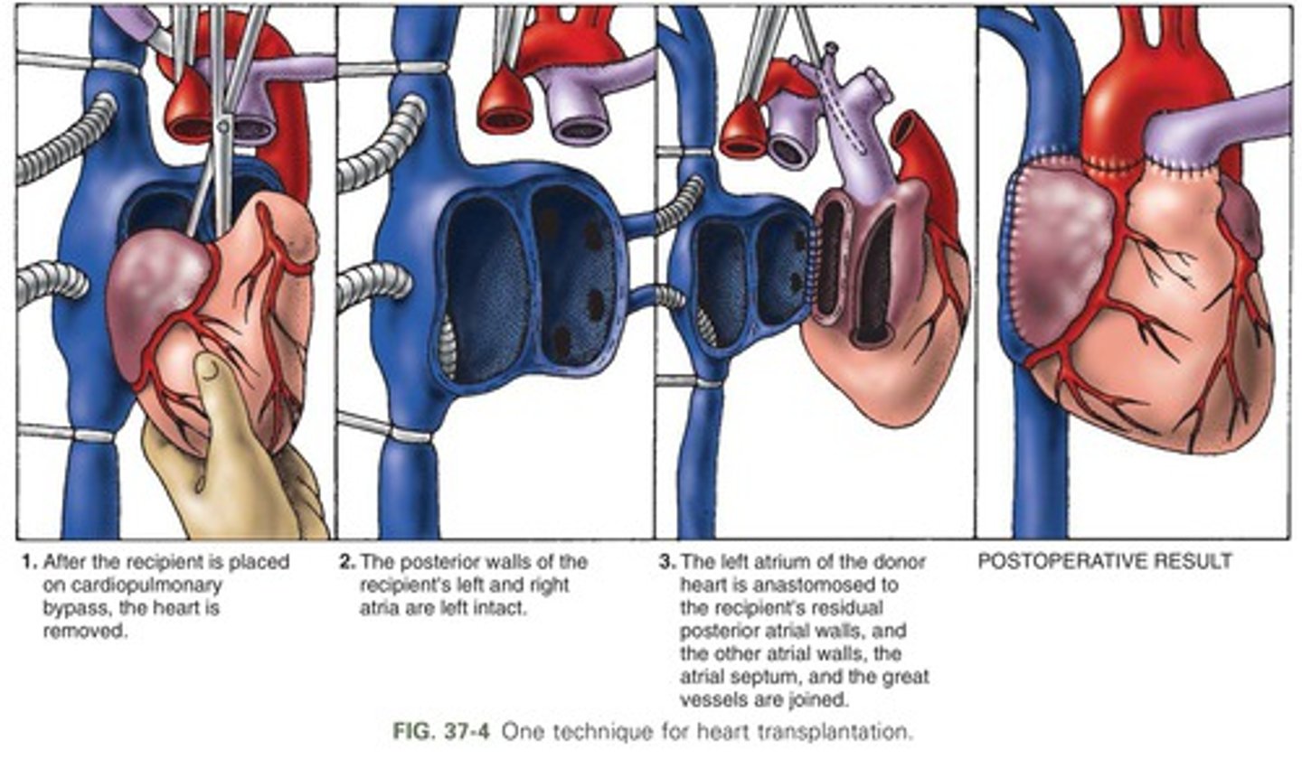 <p>the surgical replacement of a diseased heart with a healthy one</p>