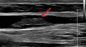<p>Patient presents with RUE swelling x 2 days. You obtain this image in the basilic vein. Is this a DVT? </p>