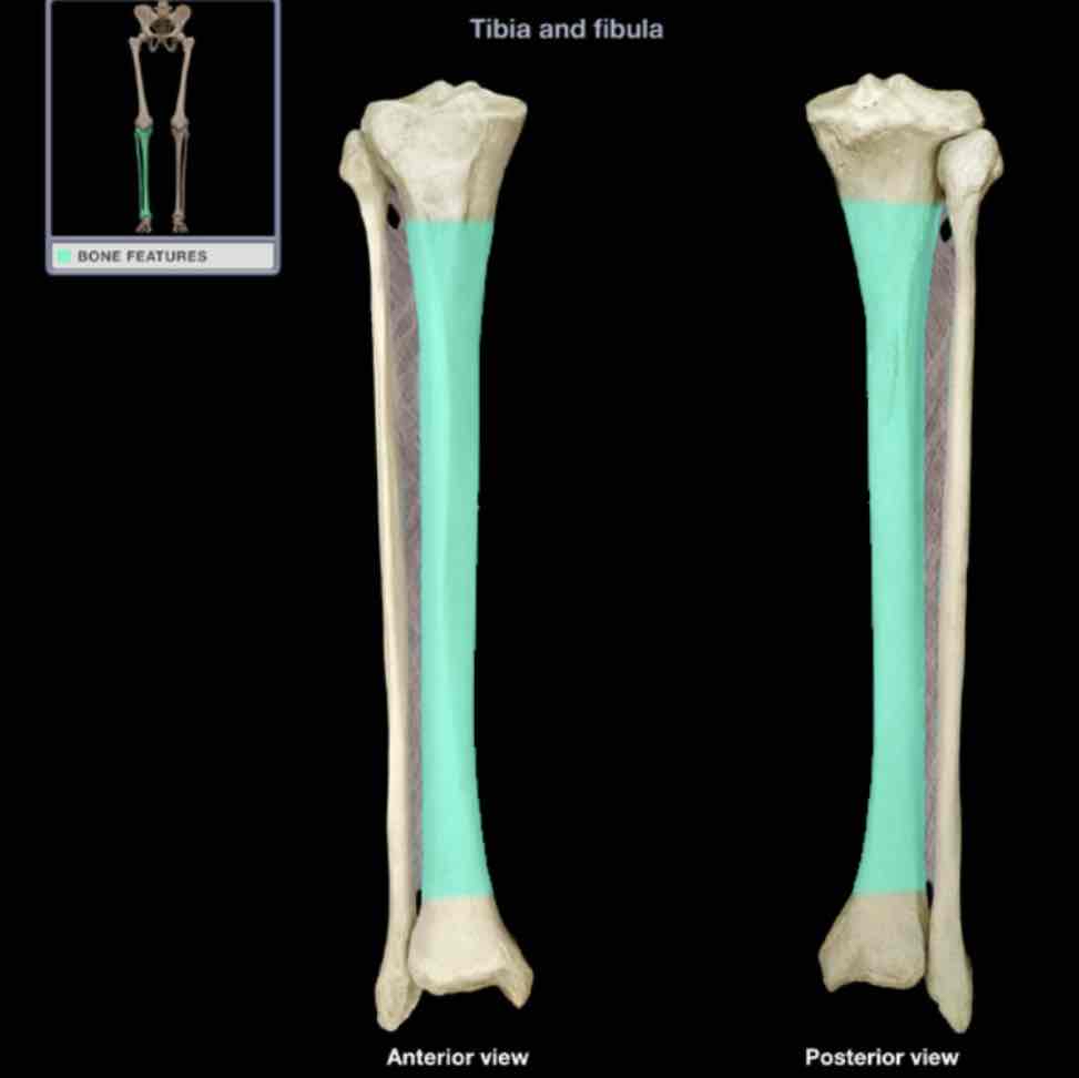 <p>Shaft of tibia</p>