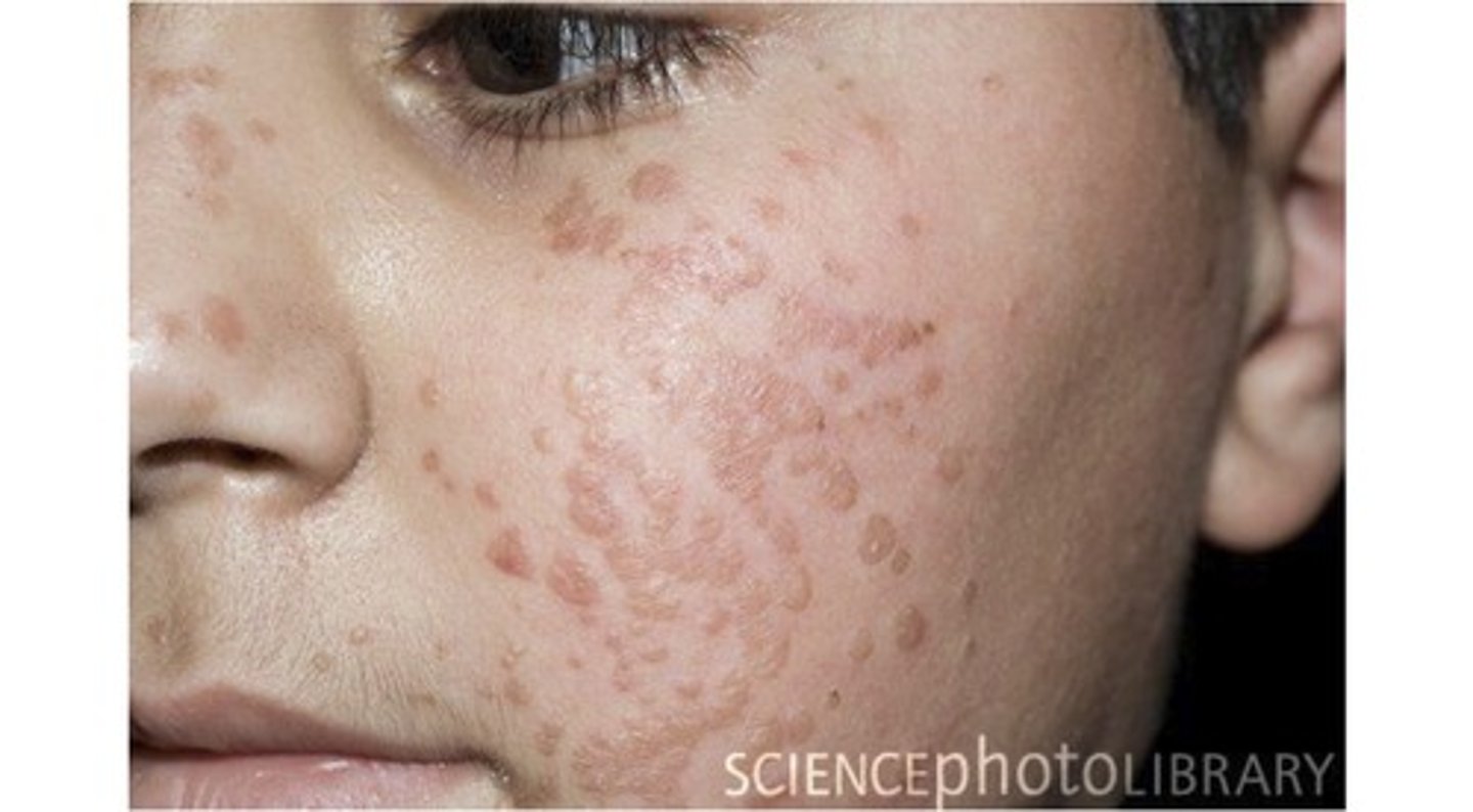 <p>smooth, skin colored lesions that develop on the face, trunk, elbows, and knees</p>