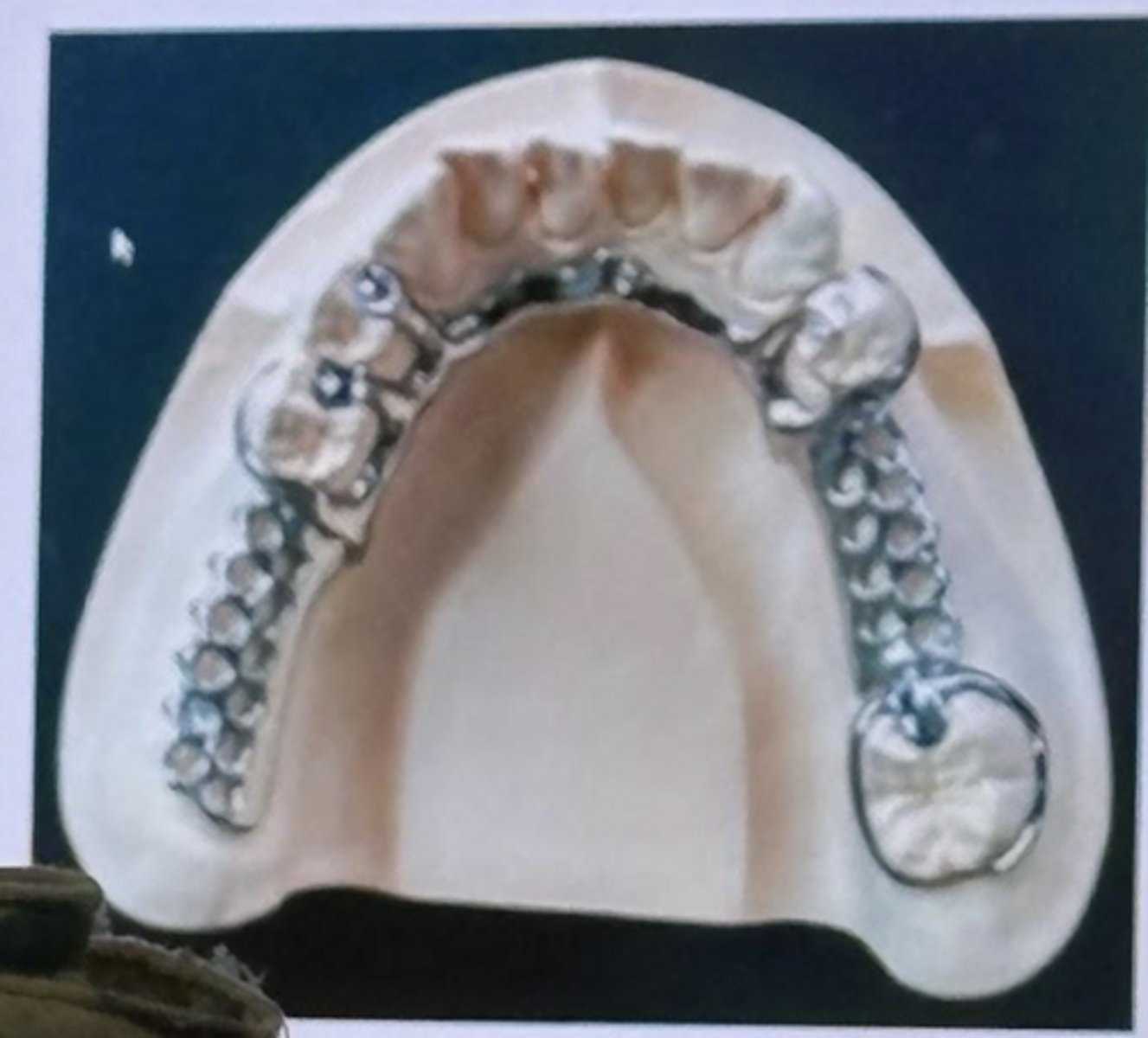 <p>-kennedy class ii mod i</p><p>-mesial rest provided indirect retention</p><p>-more ideal place for occlusal rest on 28 would be on the distal</p>