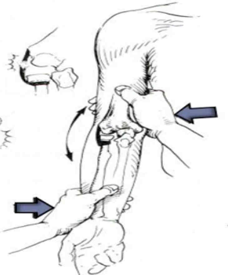 <p><strong><span>Purpose:</span></strong><span> To assess the stability of the lateral collateral ligament or LCL sprain</span></p><p><strong><span>Steps:</span></strong></p><p><span>1.The client is seated, his elbow positioned in slight flexion, his forearm supinated.</span></p><p><span>2.The therapist places one hand on the medial aspect of the elbow joint and the other hand laterally on the mid portion of distal forearm. This allows for greater ease in the application of a varus force by not allowing for any shoulder rotation.</span></p><p><span>3.The therapist applies a varus force to the elbow by pushing the Humero-ulnar joint away from the body.</span></p><p><span>&nbsp;</span><strong><span>Result:</span></strong><span> The test is positive if the client either feels pain or the therapist feels or sees gapping along the lateral aspect of the elbow.</span></p>