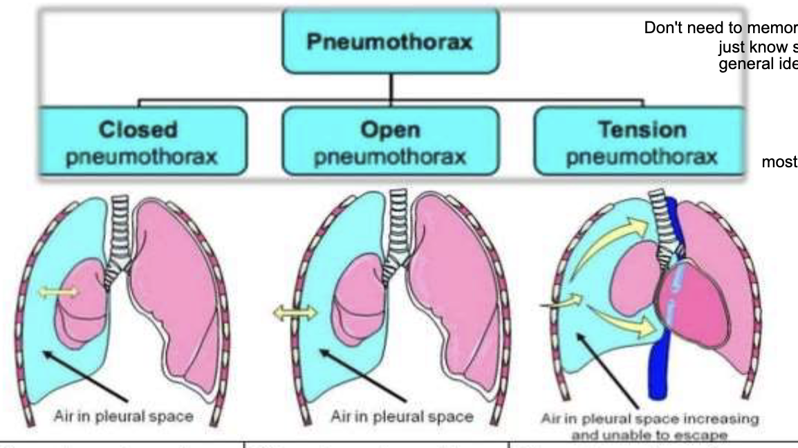 <ul><li><p>closed pneumothorax = least severity, pleural cavity pressure is &lt; the atmospheric pressure </p><ul><li><p>ex: collapsed lung, scuba diving, blunt trauma, smoking/inhaled drugs, various lung diseases </p></li></ul></li><li><p>open pneumothorax = middle severity, pleural cavity pressure is equal to atmospheric pressure</p><ul><li><p>traumatic pneumo, blunt or penetrating injury, invasive medical procedures </p></li></ul></li><li><p>tension pneumothorax = most severity, pleural cavity pressure is &gt; the atmospheric pressure </p><ul><li><p>trauma causing one way valve </p></li></ul></li></ul><p></p>