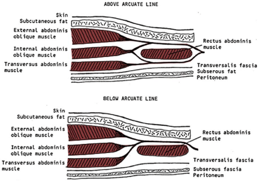 <p>A. Mạc ngang + phúc mạc</p><ul data-type="taskList"><li data-checked="true" data-type="taskItem"><label><input type="checkbox" checked="checked"><span></span></label><div><p>Ở <u>dưới</u> đường cung: </p><ul data-type="taskList"><li data-checked="false" data-type="taskItem"><label><input type="checkbox"><span></span></label><div><p>Cân cơ chéo bụng ngoài, trong và ngang bụng đều đi ra phía trước cơ thẳng bụng </p></div></li><li data-checked="false" data-type="taskItem"><label><input type="checkbox"><span></span></label><div><p><span data-name="arrow_right" data-type="emoji">➡</span> Lá sau chỉ còn lại mạc ngang + phúc mạc.</p></div></li></ul></div></li></ul><p></p>