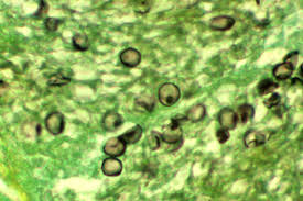 <p>Pneumocystis jirovecci (carinii)</p>