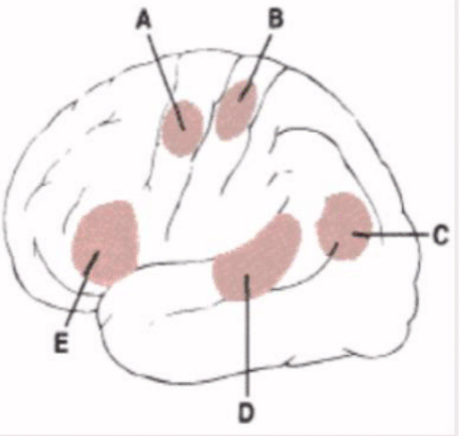 <p>Lesion in this area will result in cortical deafness</p>