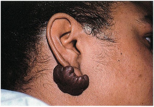 what type of scar formation is this?
