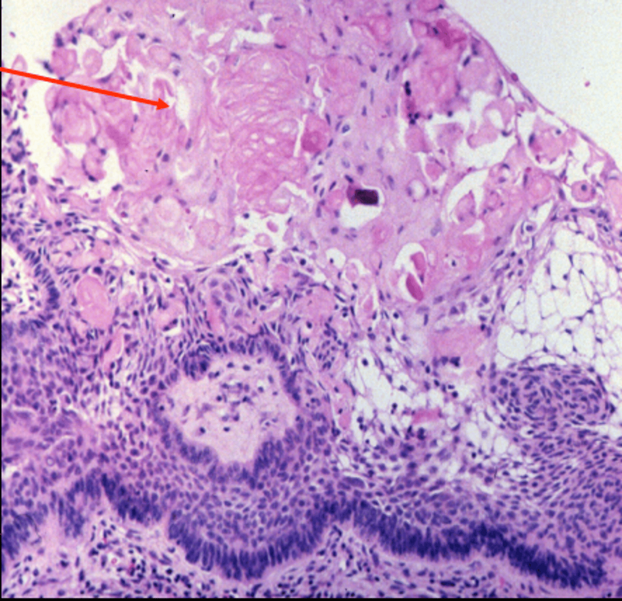 <p>CPH tumor type that occurs mostly in children</p>