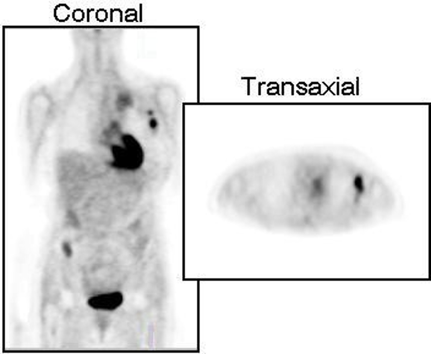 <p>Malignant cells have a higher need for glucose, allowing FDG 18 to accumulate in these cells for imaging.</p>