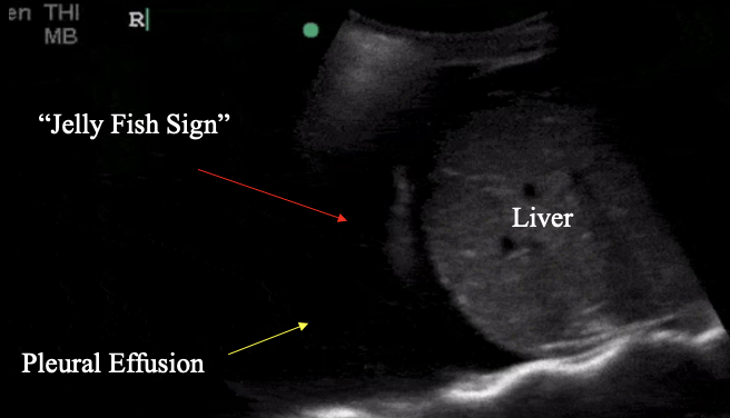 <p>What is the Jelly fish sign?</p>