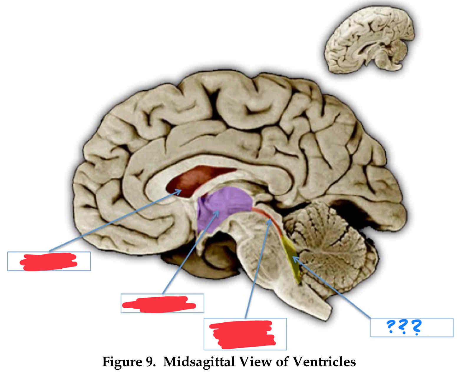<p>between the cerebellum and pons</p>