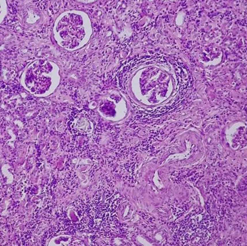 <p>Pyelonephritis purulenta </p>