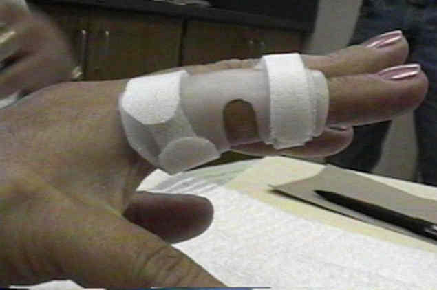 <p>-used to keep the finger in extension, typically for boutonniere deformity<br>-should be worn continuously for 6 weeks for healing </p>