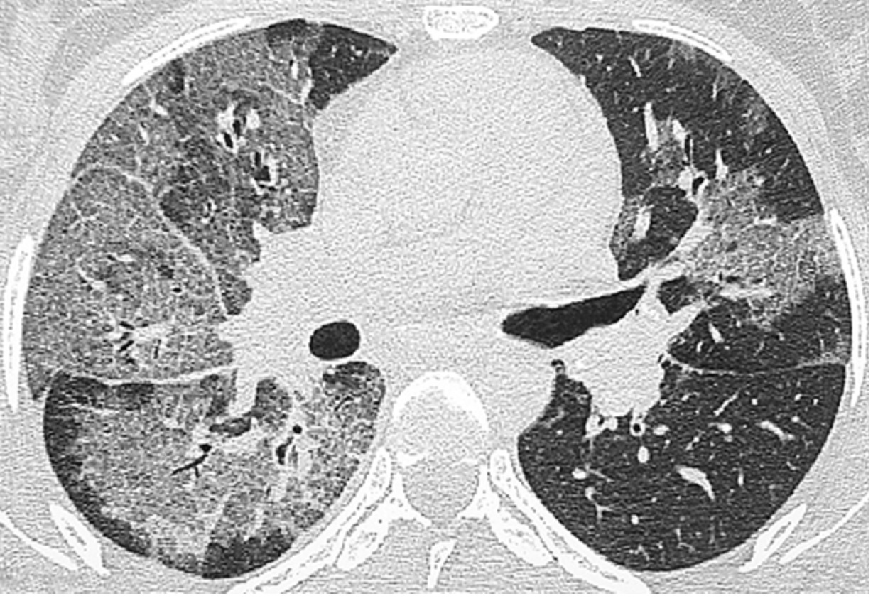 <p>Patient reports to the ER for abrupt onset SOB. Patient reports that they are HIV positive. Vitals are stable with the exception of a temp of 102.5 and 28 RR. On a physical exam you note bibasilar crackles. CXR shows ground glass appearance. ABG/VBG show hypocapnia and hypoxemia. What are you thinking and what is your treatment plan?</p>