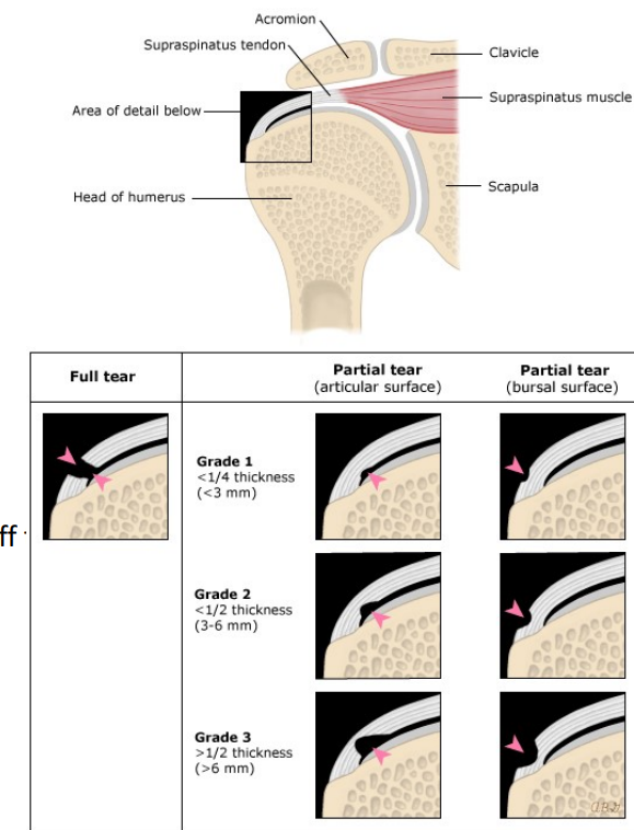 <p>Frozen shoulder/adhesive capsulitis</p>
