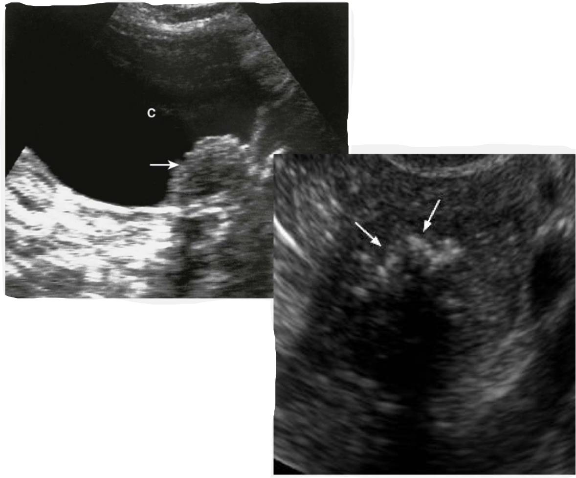 <p>abnormal uterine bleeding</p><p>Age: 40-80 yo</p>
