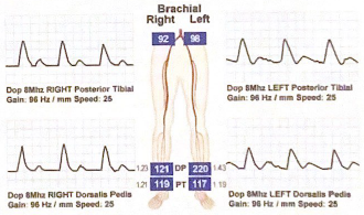 <p>Explain why the brachial pressures are low compared to the ankle pressures. What 2 disease processes could be going on?</p>