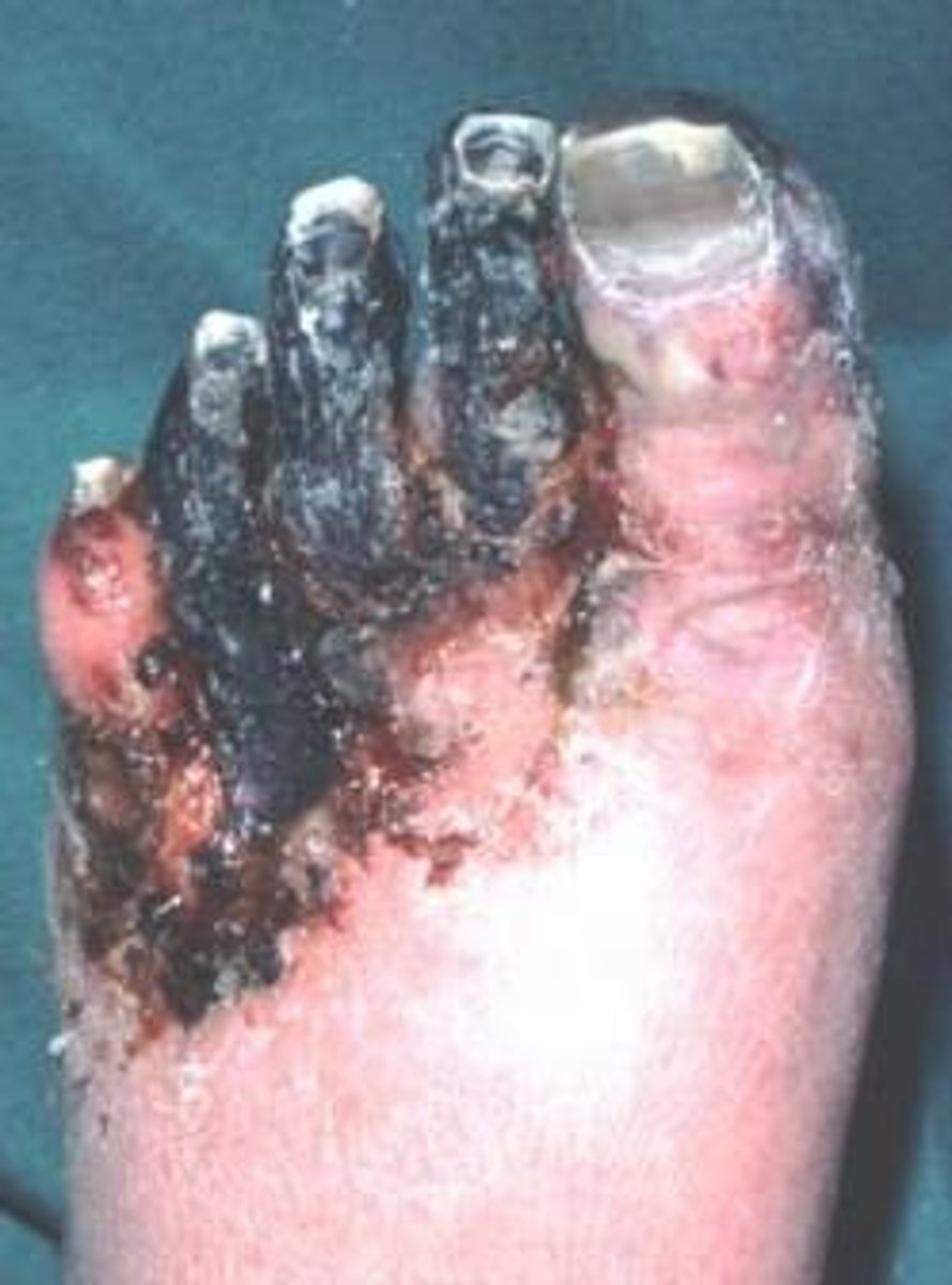 <p>Visible tissue necrosis caused by loss of blood supply</p>
