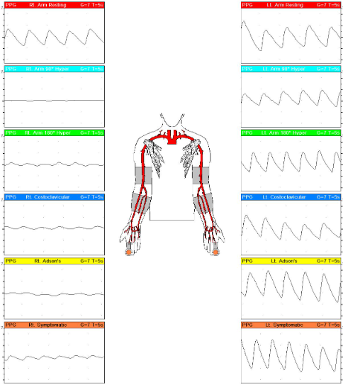 <p>30 y/o male patient presents with tingling and pain RUE in specific positions. No medical history. Indirect UE testing ordered and you obtain these results with PPG sensor and PRV waveforms.</p><p>1.What is possible diagnosis? </p><p>2.Which position causes cessation of blood flow?</p>