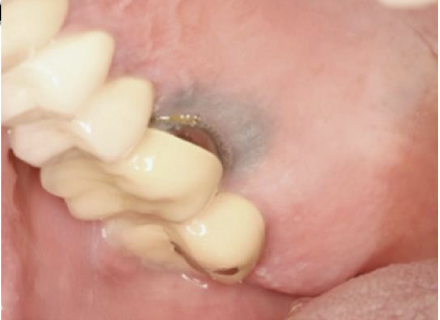 <p>What type of pigmented lesion?</p>