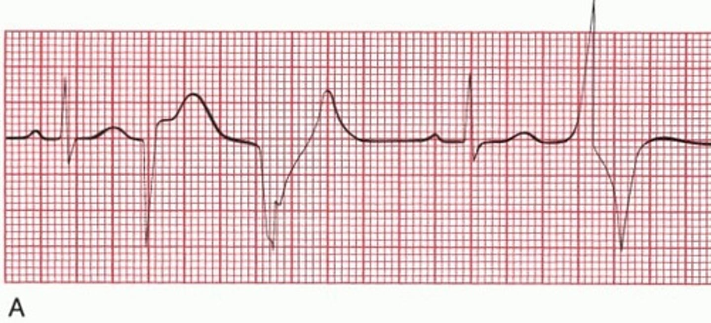 <p>PVC (Premature ventricular contractions)</p>