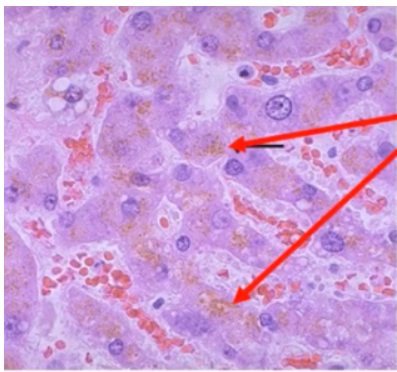 <p><span style="font-family: arial">Pigment granules that appear yellowish-brown; are of coalesced residual bodies common in long-lived cells</span></p>