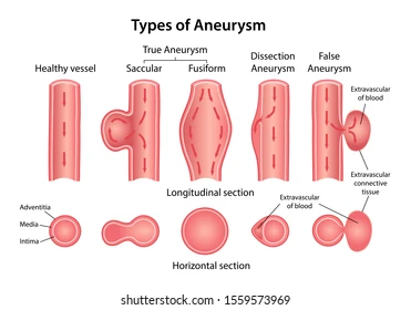 <p>include healthy. vesel, saccular, fussiform, dissection, and false,  each differing in shape and location</p>