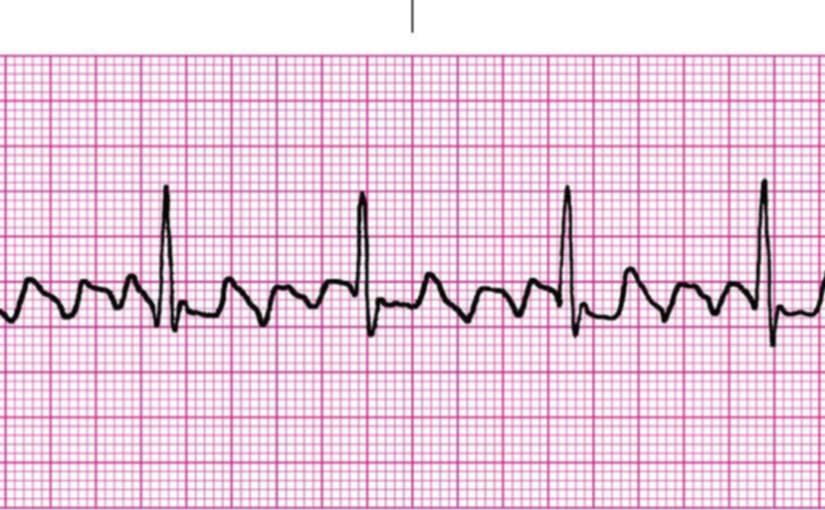 <p>what rhythm is shown in the ECG?</p>