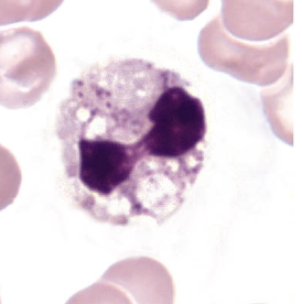 <p>what nuclear abnormality is associated with the following:</p><ul><li><p>dying cell</p></li><li><p>nucleus very dark/dense</p></li><li><p>filaments still visible</p></li></ul><p></p>