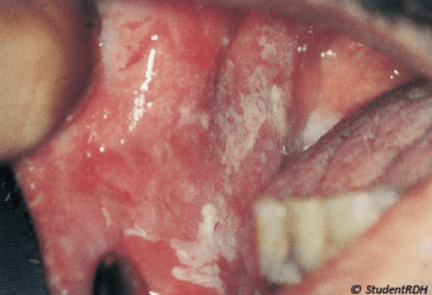 <p>PAINFUL</p><p>• history of topical aspirin use</p>