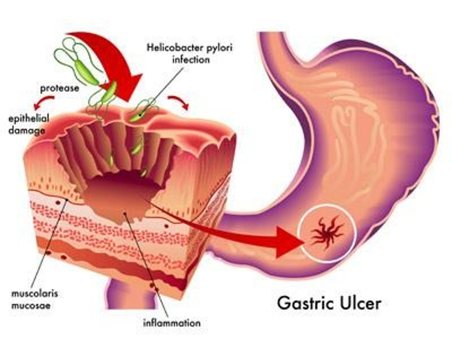 <p>Lesions in the stomach lining caused by the acid-tolerant bacterium Heliobacter pylori.</p>