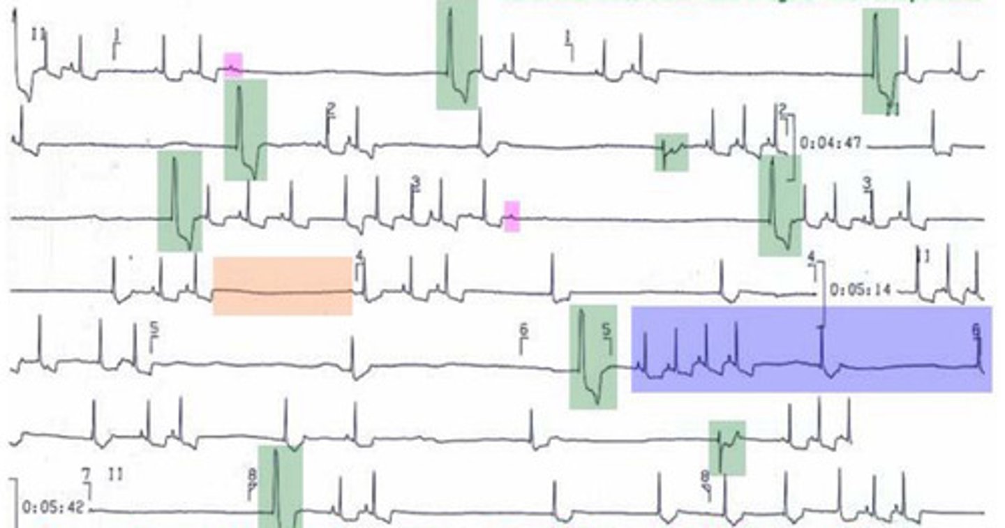 <p>What is this ECG showing?</p>