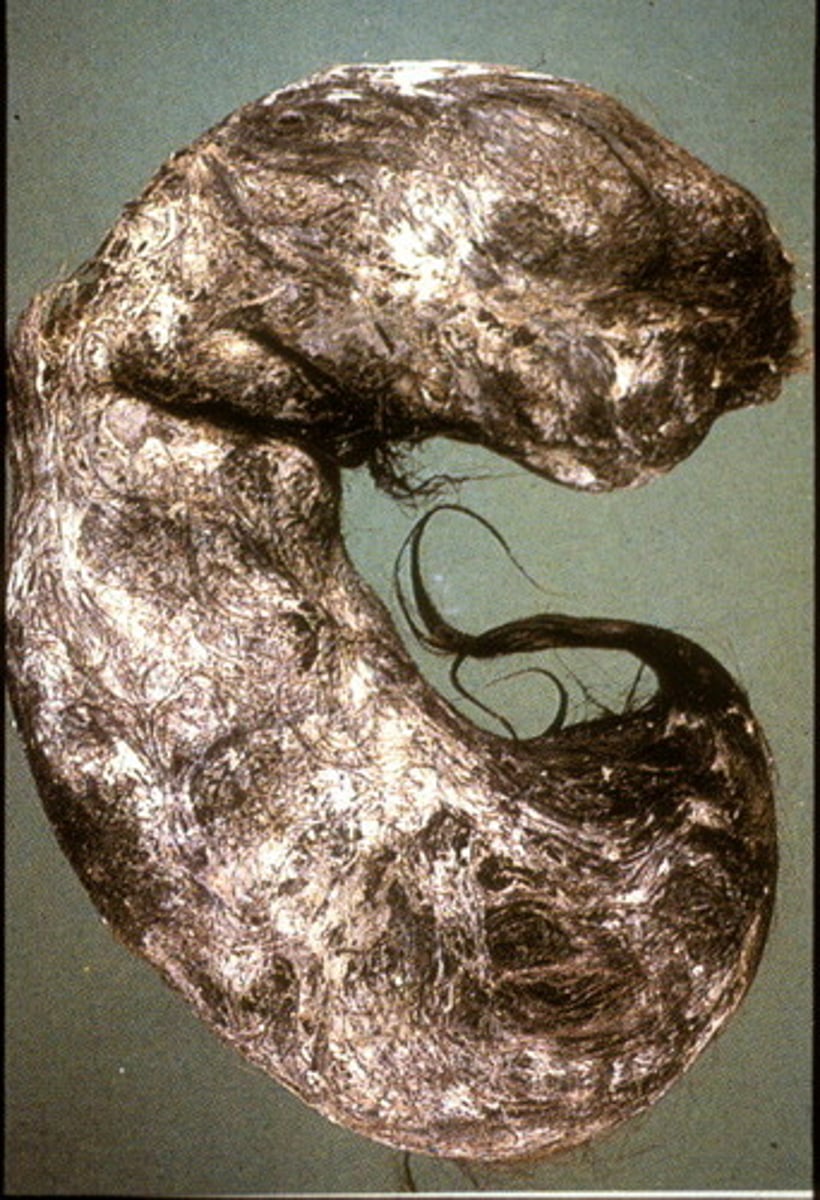 <p>Concentrations of nondigestable materials formed in the stomach</p><p>Tricho: hair</p><p>Phyto: vegetable fibers</p><p>Pharmaco: undigested meds</p><p>Lacto: milk curd</p>